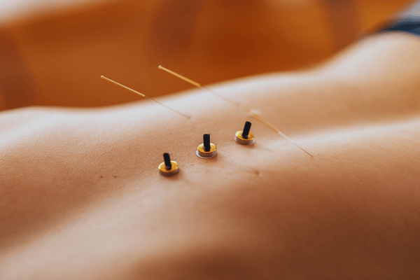 Acupuncture + Moxibustion Combined