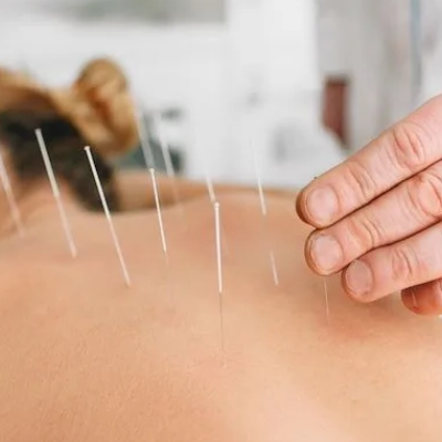 Acupuncture for Back Pain
