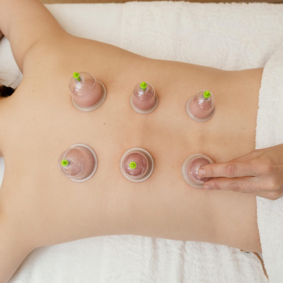 Cupping Therapy for Back Pain