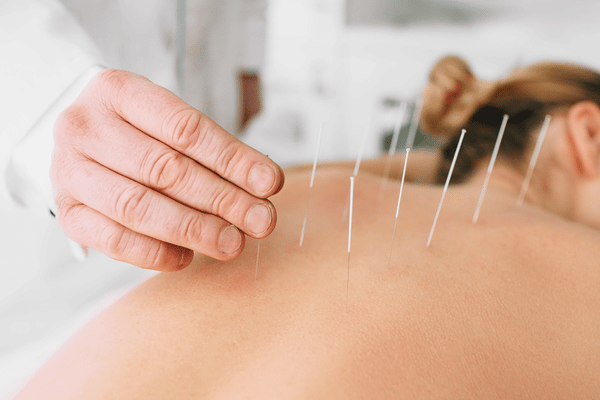 Acupuncture needle treatment and WHO standards
