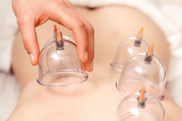 Cupping & Hijama Therapy
