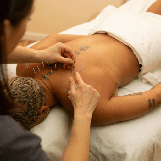 How Acupuncture Works for Back Pain