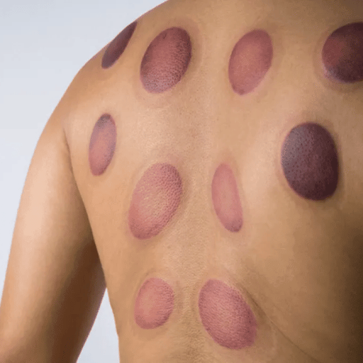 A 5,500-Year Practice Reborn: What Cupping Therapy Is