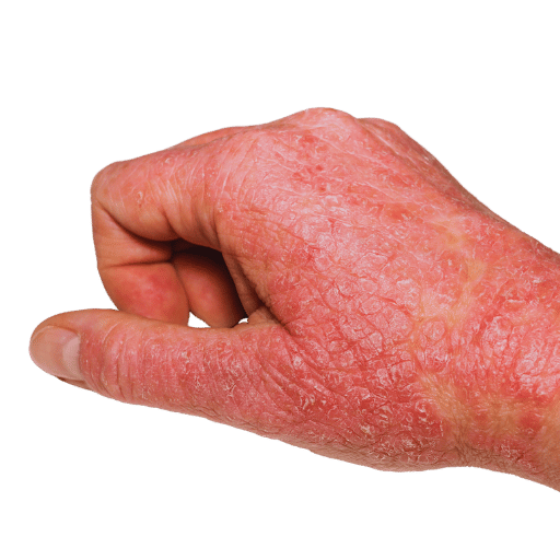 Why Eczema Keeps Coming Back — The TCM "Root vs Branch" Framework