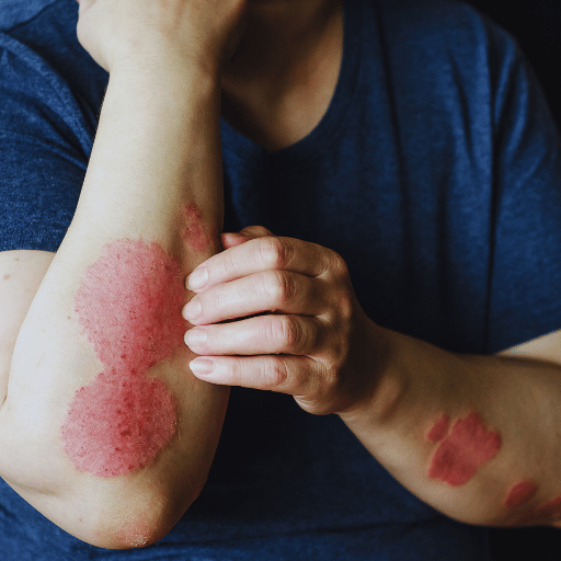 Five TCM Eczema Patterns — Which One Describes Your Skin?