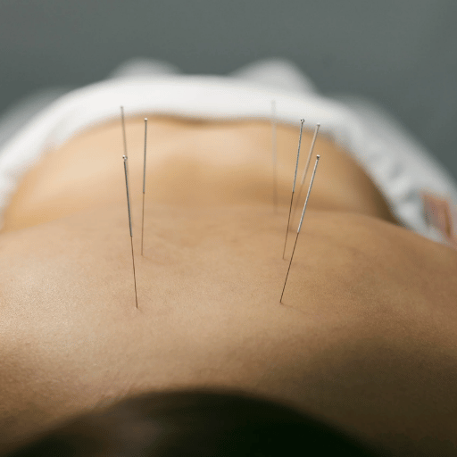 Does Acupuncture Really Work for Lower Back Pain? What 2025 Research Shows