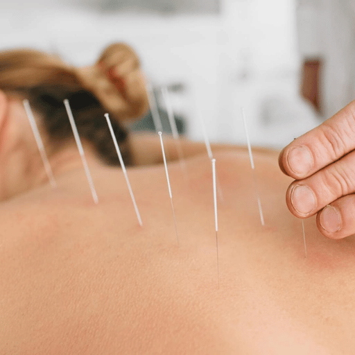 Eight Myths About Acupuncture and Back Pain — Fact-Checked