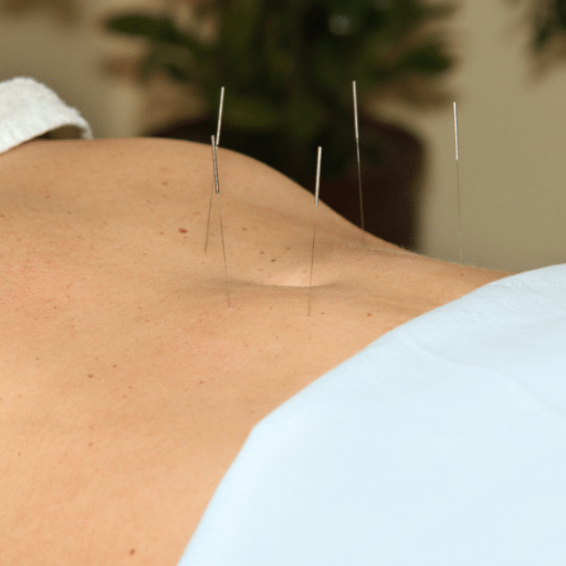 What Is Fertility Acupuncture?