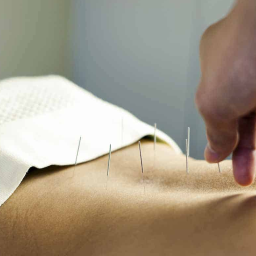 Back Pain Affects 628 Million People — Why Acupuncture Is Gaining Ground