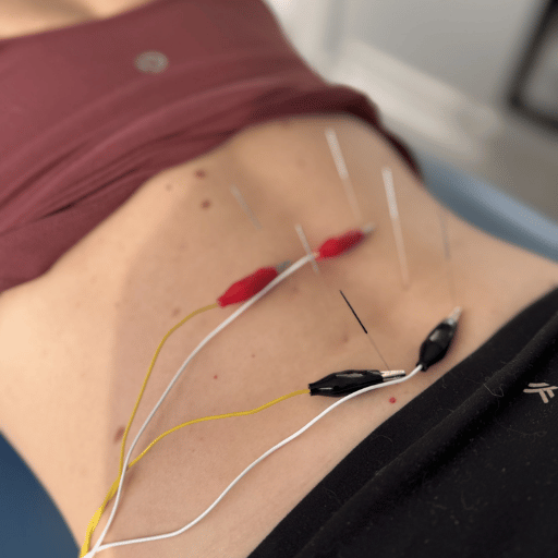 Types of Back Pain Acupuncture Can Address