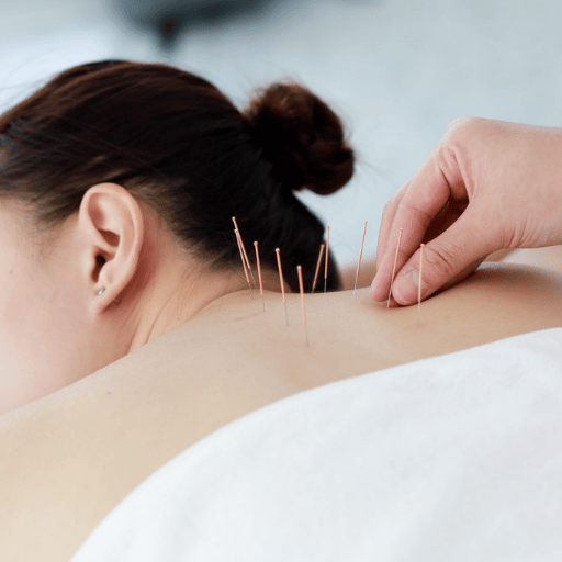 Acupuncture vs Dry Needling: 7 Real Differences