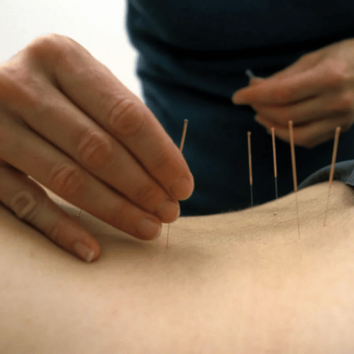 Key Acupuncture Points Used for Lower Back Pain