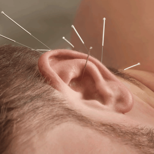 Body, Ear & Electroacupuncture — Which Type Delivers the Best Results?