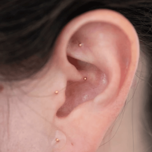 Ear Acupuncture (Auricular) Before and After — What's Different