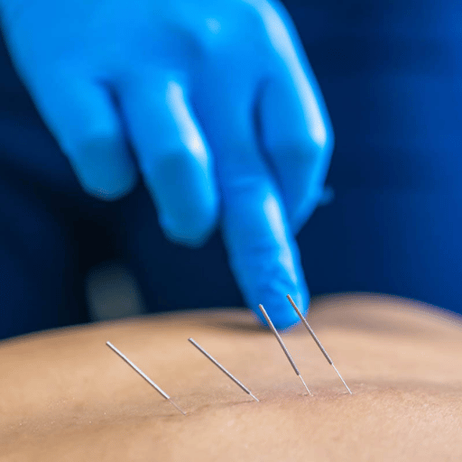 Acupuncture vs Dry Needling: Why the Difference Matters for Risk