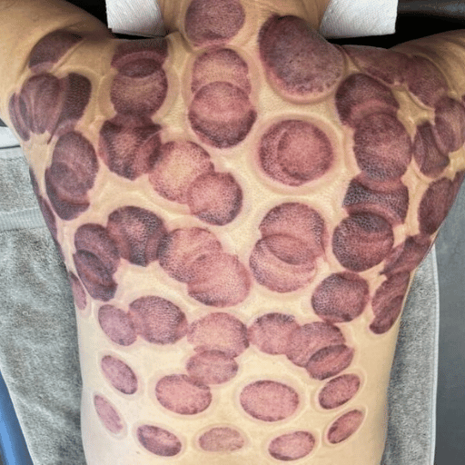 Cupping Marks Decoded: What Bruises Mean (and What They Don't)
