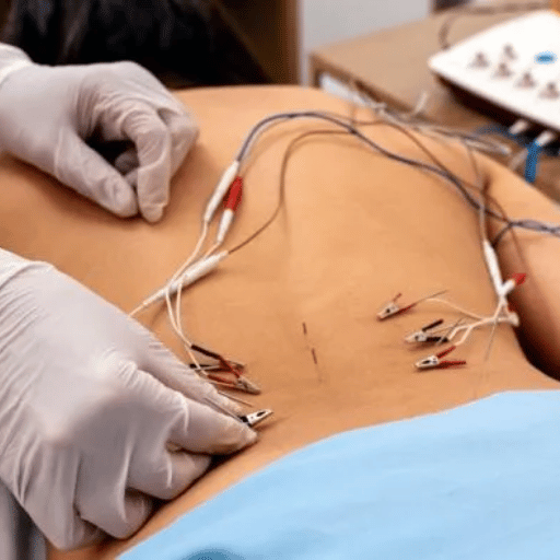 Acupuncture vs. Dry Needling: Why the Difference Matters