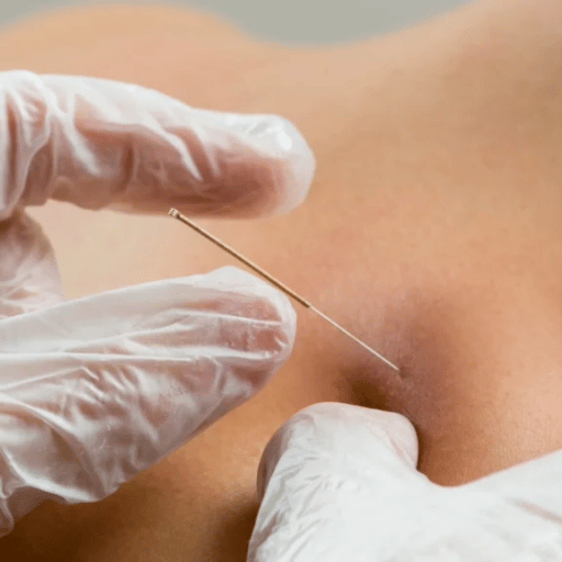 Types of Acupuncture: From Manual to Battlefield Protocols