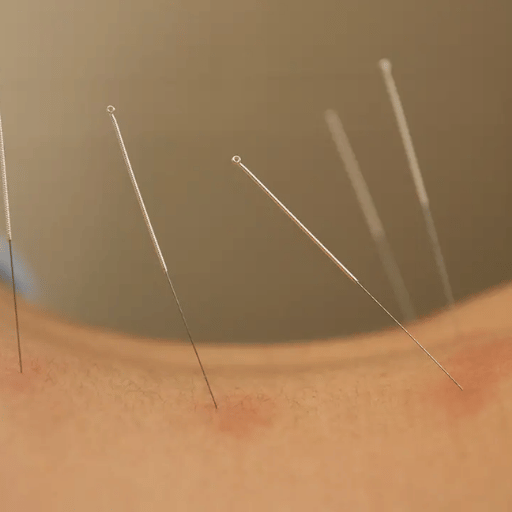 The Outlook: 2025 Research and Where Acupuncture for Back Pain Is Heading
