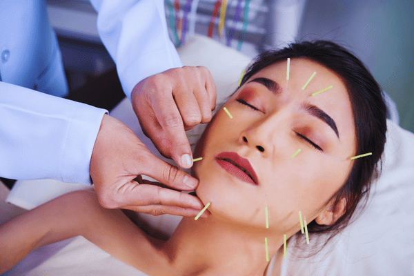 Acupuncture for Anxiety