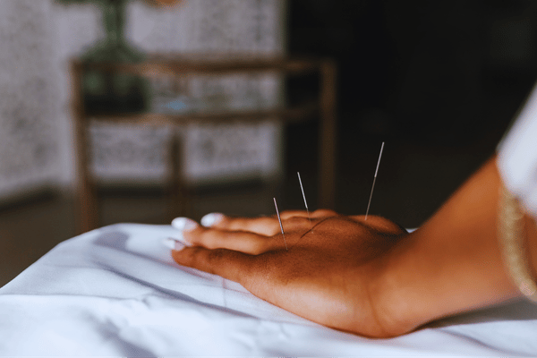 Acupuncture for Arthritis treatment session