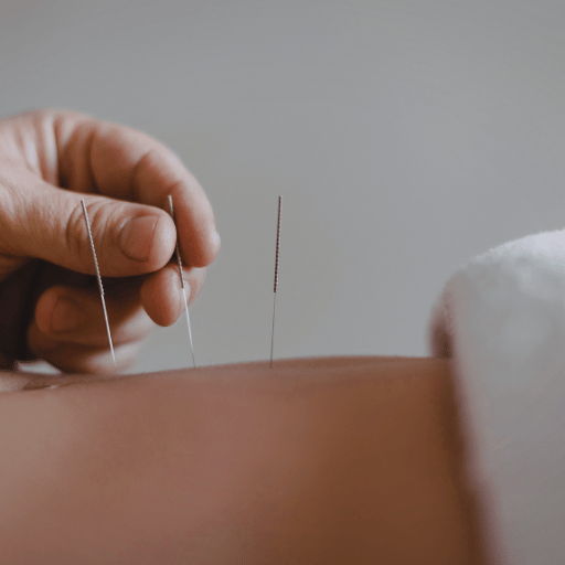 IVF Acupuncture Support