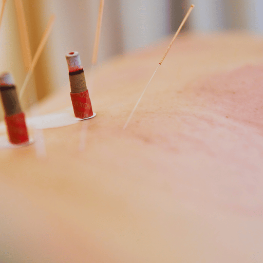 Moxibustion & Warm Needle