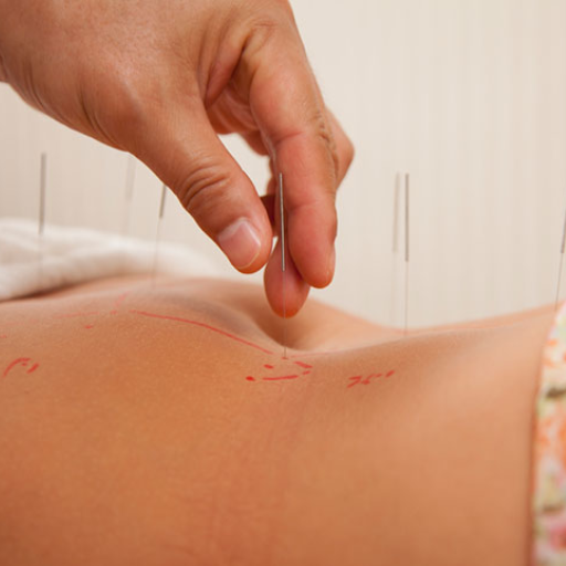 Fertility Conditions Acupuncture Can Treat: PCOS, Endometriosis, and More