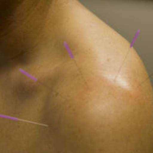 Acupuncture for Frozen Shoulder — What the Evidence Shows