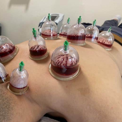 Is Hijama Halal or Haram? The Short Answer