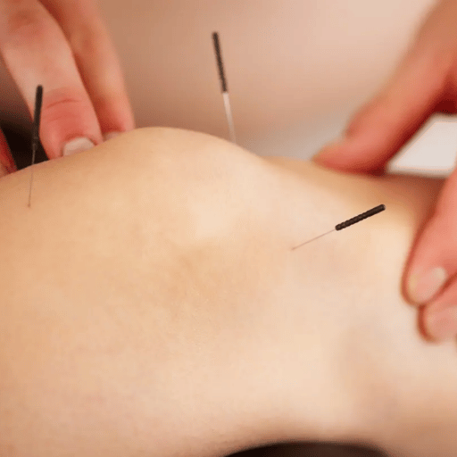 So, Does Acupuncture Hurt? The Honest Answer
