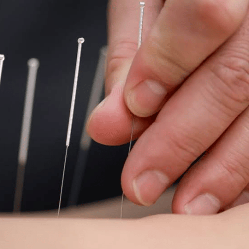 The Short Answer: Is Acupuncture Halal or Haram?