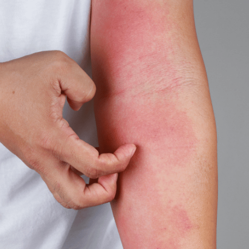 What to Expect From a TCM Eczema Consultation