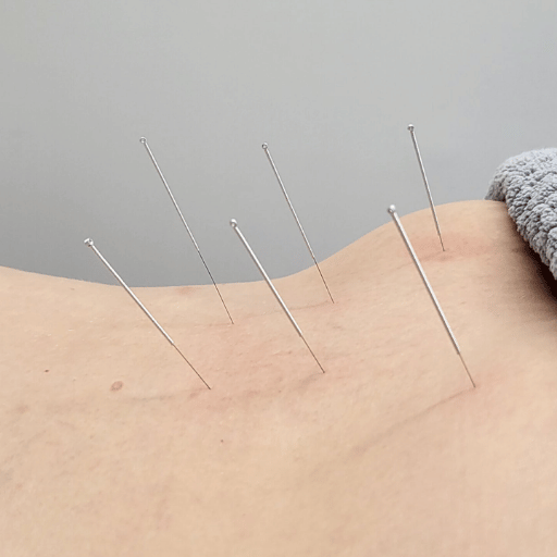 Cost of Acupuncture vs Dry Needling