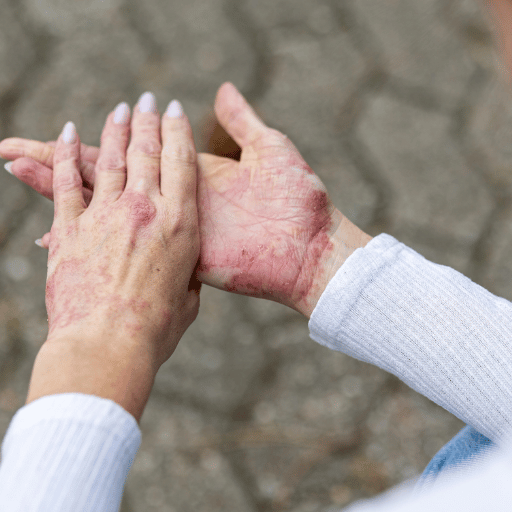 Outlook: Eczema and the Rise of Integrative Dermatology