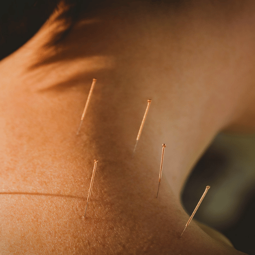 Acupuncture, Explained