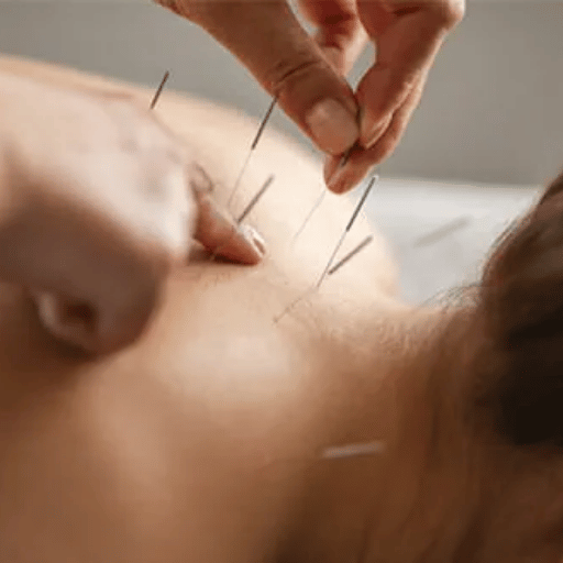 What Acupuncture Actually Feels Like: The 5-Sensation Spectrum