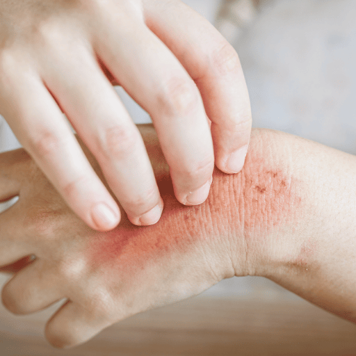 The Three Main TCM Patterns Behind Eczema