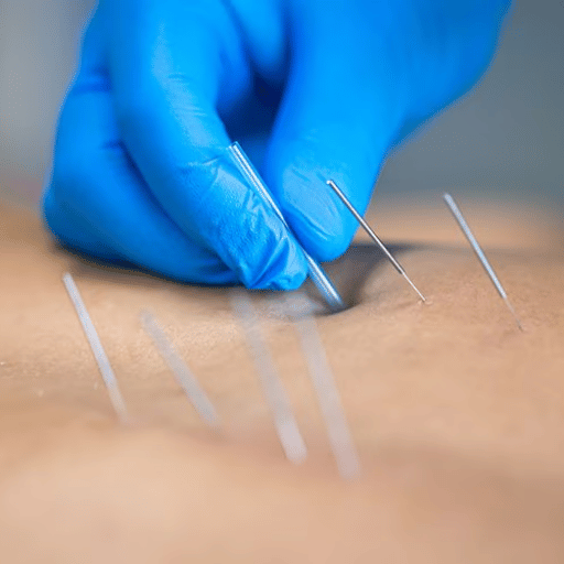 Dry Needling, Explained