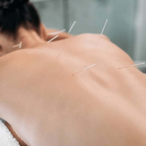 How Often Should You Get Acupuncture? The 4-Phase Treatment Course