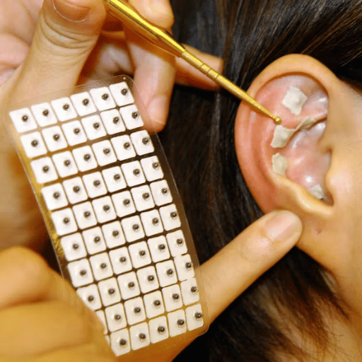 Ear Acupuncture and Ear Seeds for Anxiety
