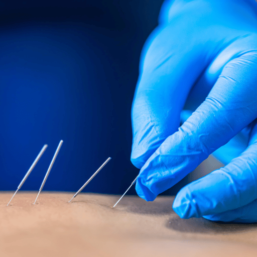 Depth and Sensation: Dry Needling vs Acupuncture