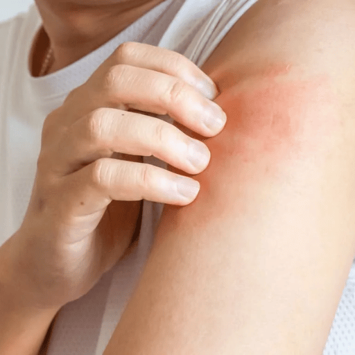 Does Chinese Medicine Actually Work for Eczema?