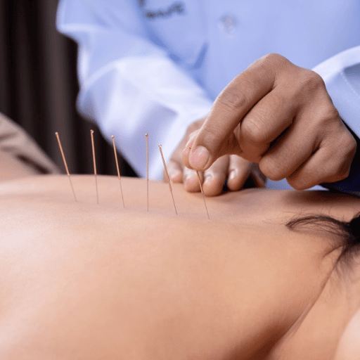 Acupuncture vs Medication, Therapy, and Other Natural Remedies