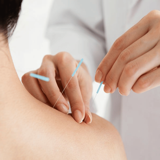 Maintenance Acupuncture: How Often After You Feel Better