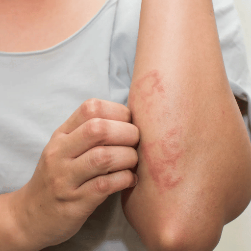 Diet and Daily Habits TCM Recommends for Eczema