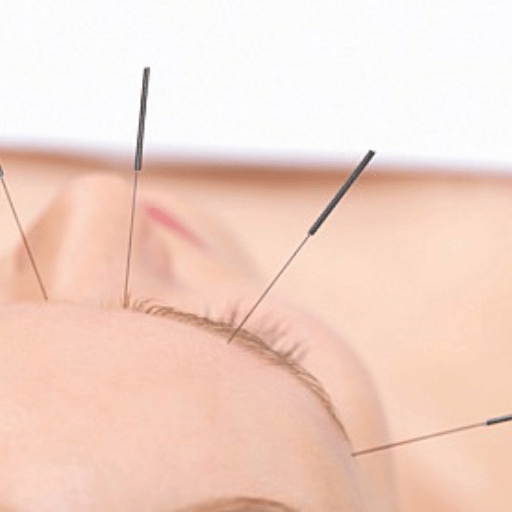 Acupuncture in Dubai in 2026: What's Changing